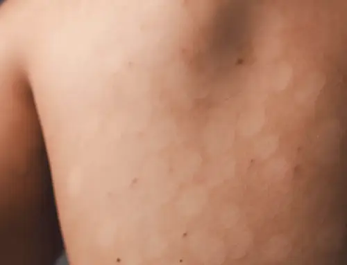 Micosi della pelle: cosa sono, come si presentano e come riconoscerle