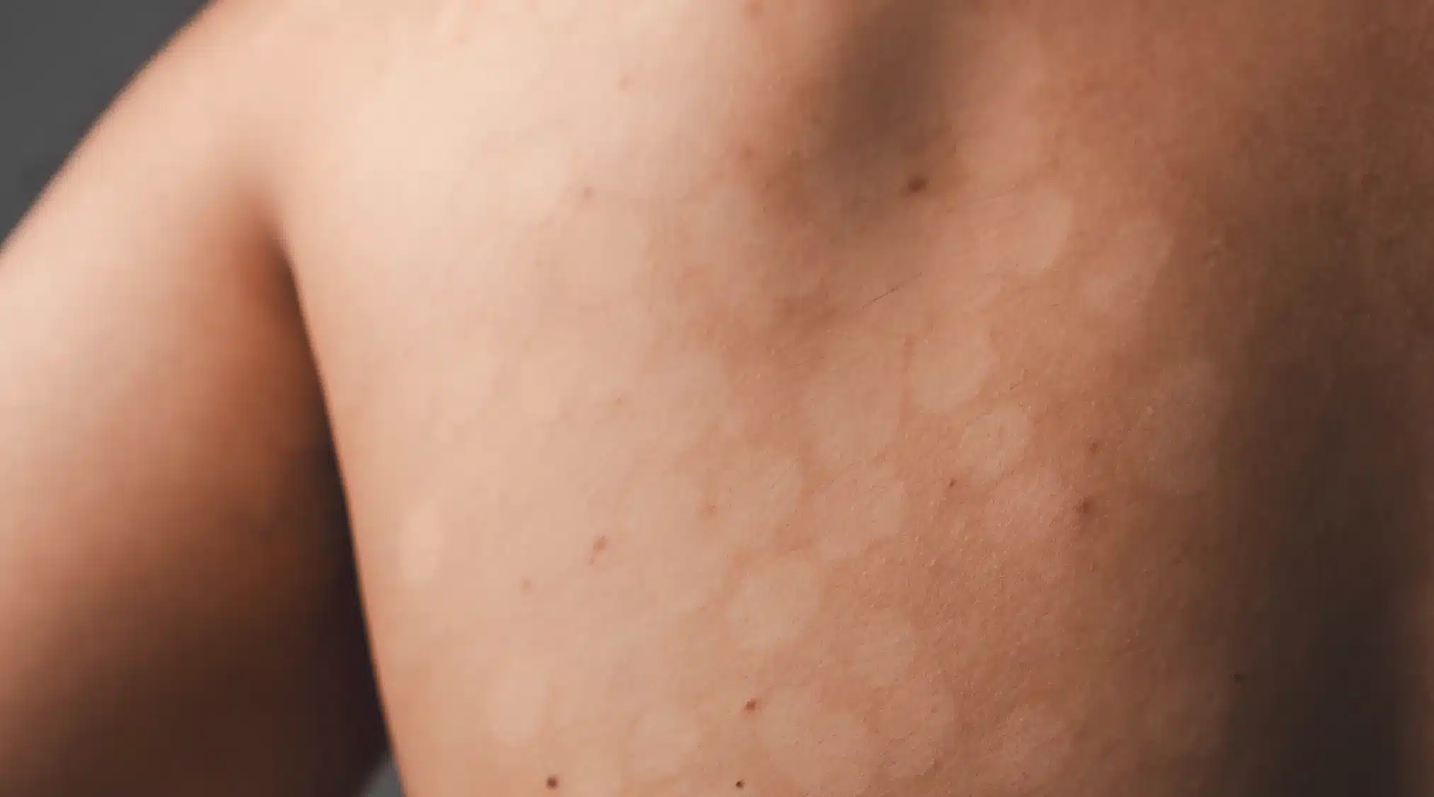 Micosi della pelle | Galenia